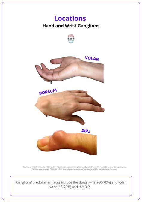 icd 10 code for right wrist ganglion cyst|2025 ICD